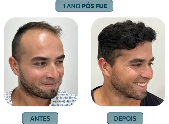 resultados implante capilar novo fio -picos